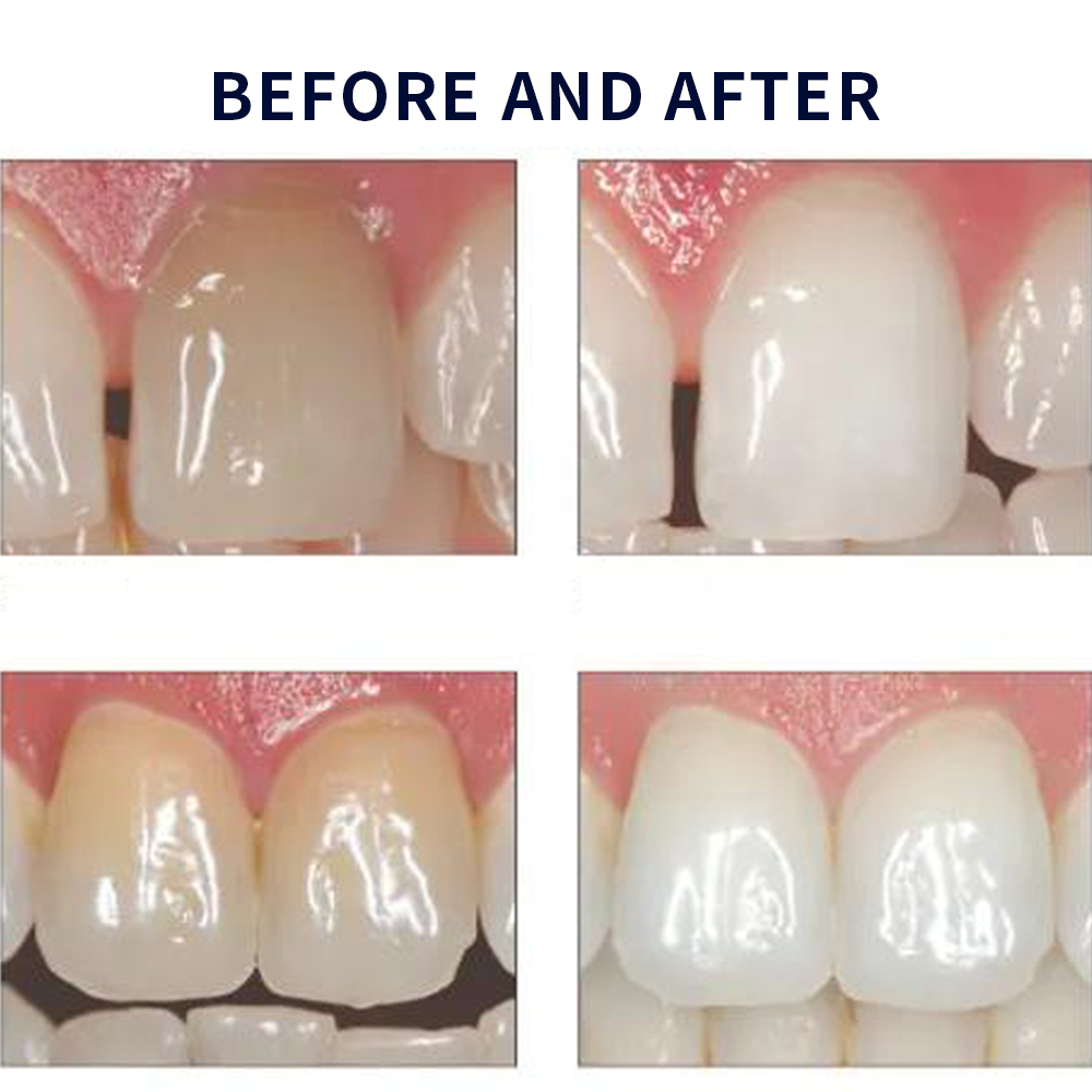 Opalescence Whitening 20% PF 2 - Teeth Whitening Bleaching Kit ulasan dan harga