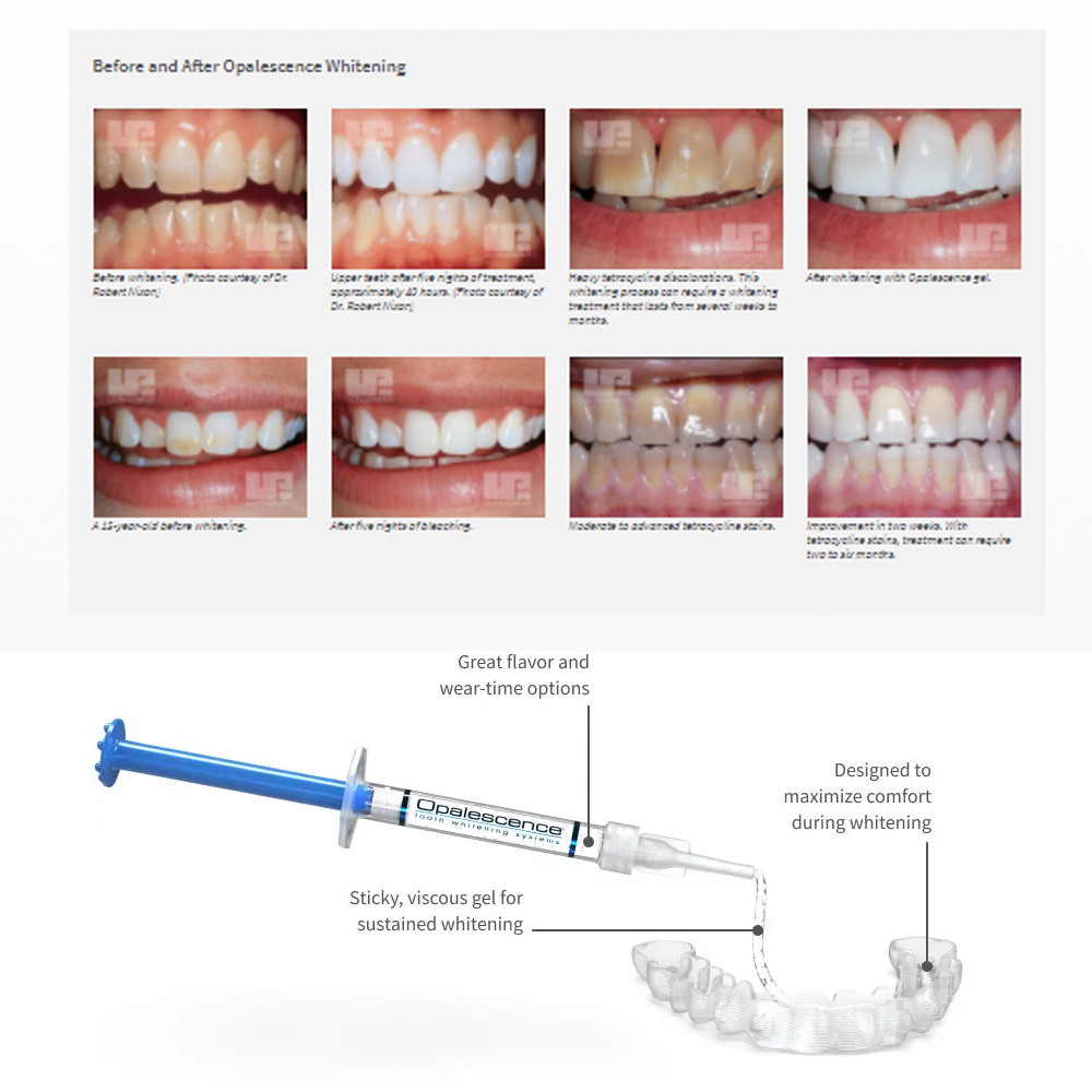 Opalescence Whitening 20% PF 2 - Teeth Whitening Bleaching Kit ulasan dan harga