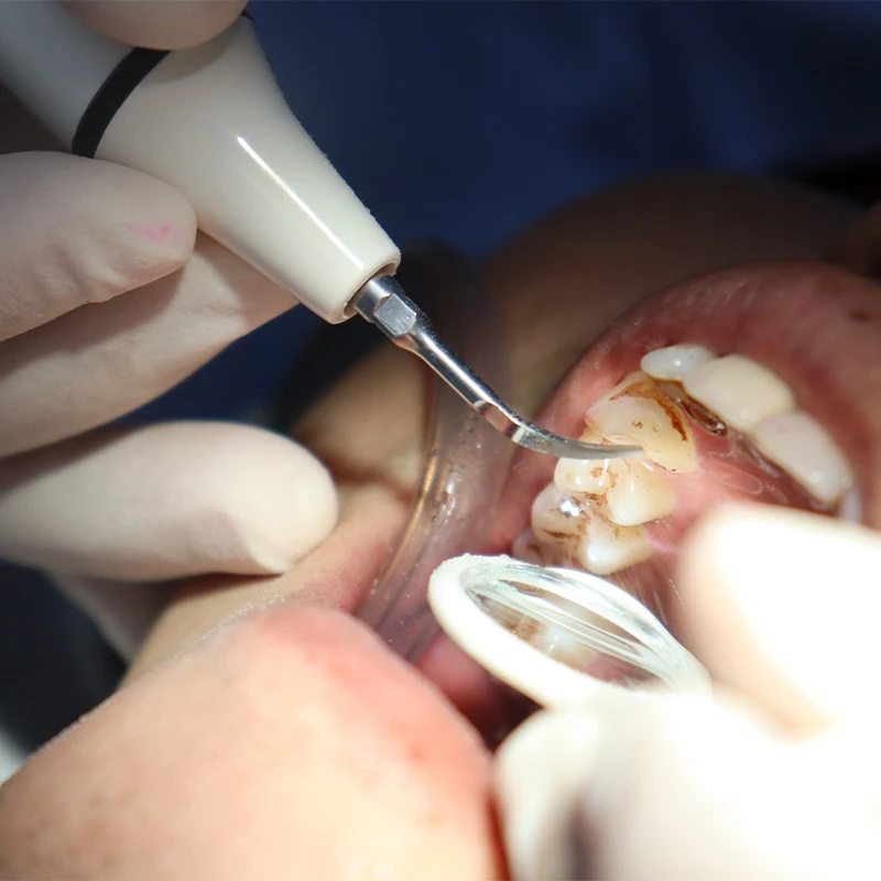 Scaler Handpiece Tube Cable fo - Teeth Whitening Youtube ulasan dan harga