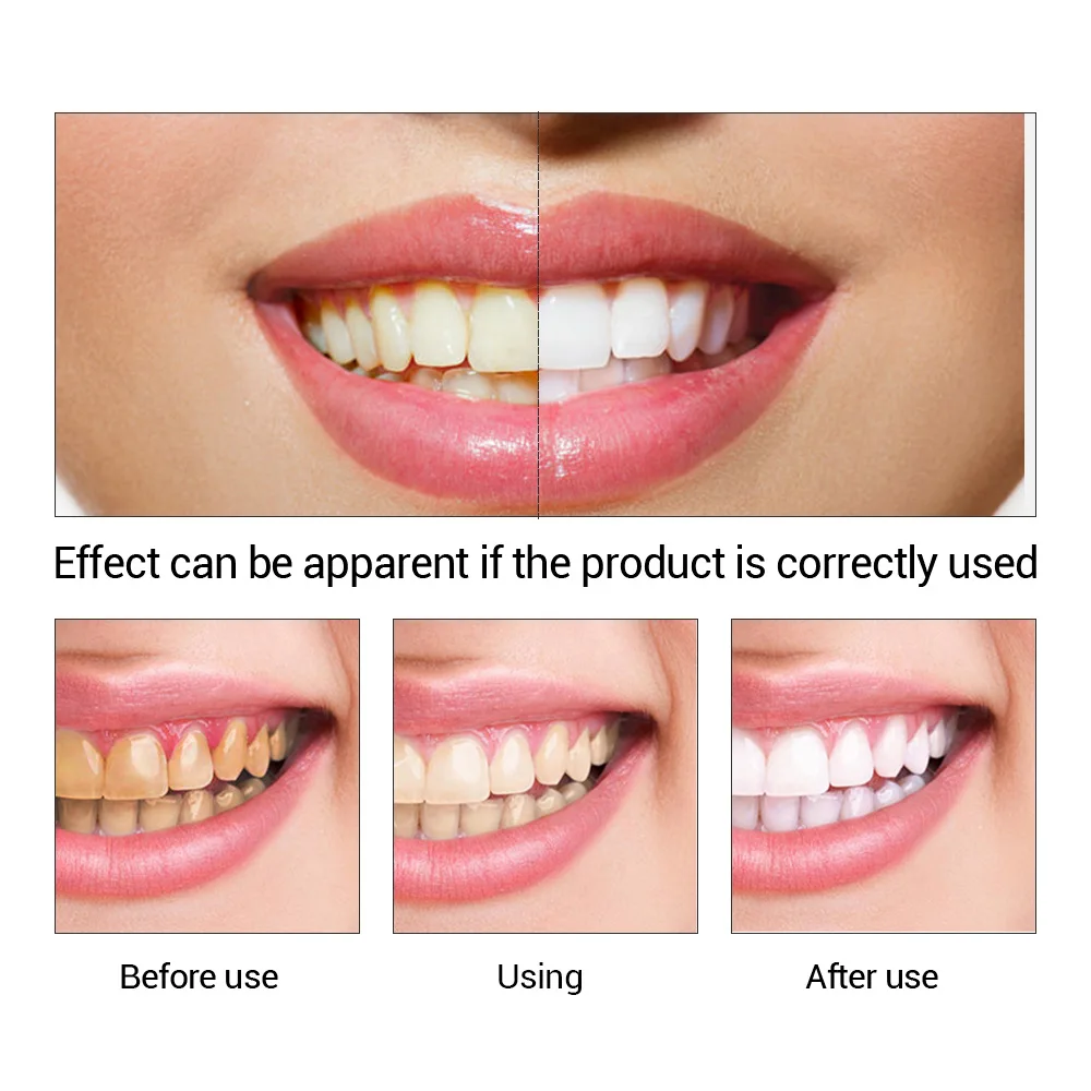 FTEENPLY Teeth Whitening Essen - Teeth Whitening Ai ulasan dan harga