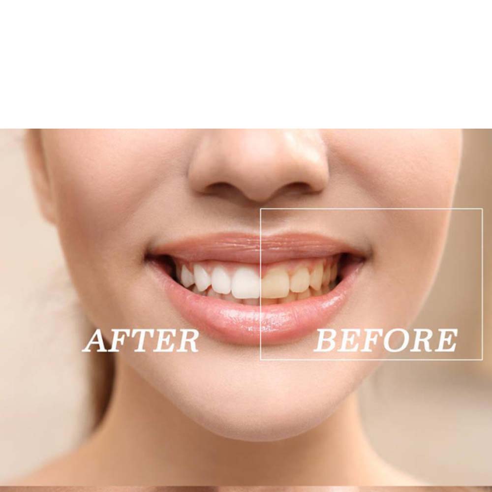 Top Quality Peroxide Teeth Whi - Teeth Whitening Bleaching Kit ulasan dan harga
