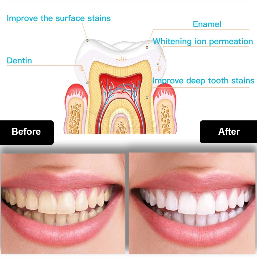Dental Teeth Whitening Kit Min - Teeth Whitening That Works ulasan dan harga